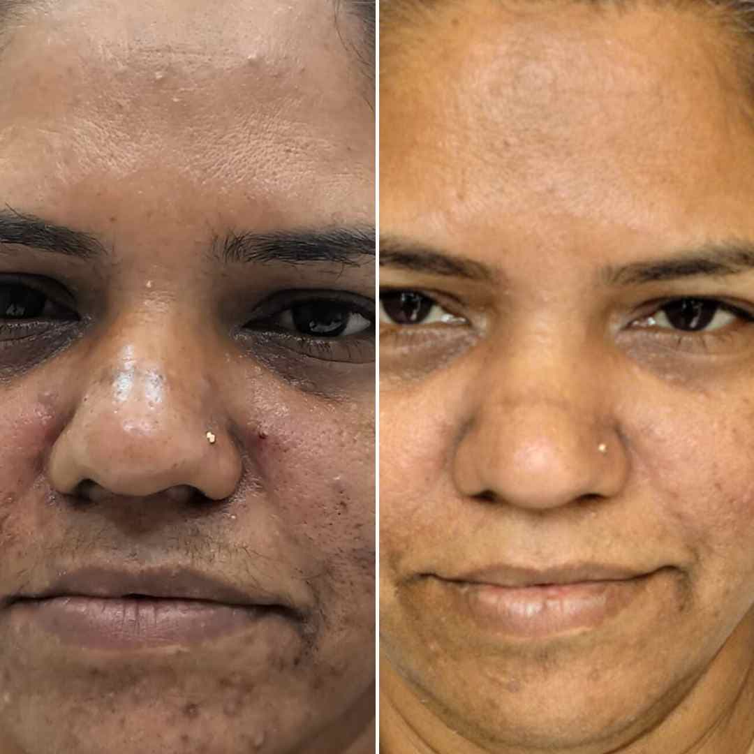 Black-peel-+-PRP.jpg