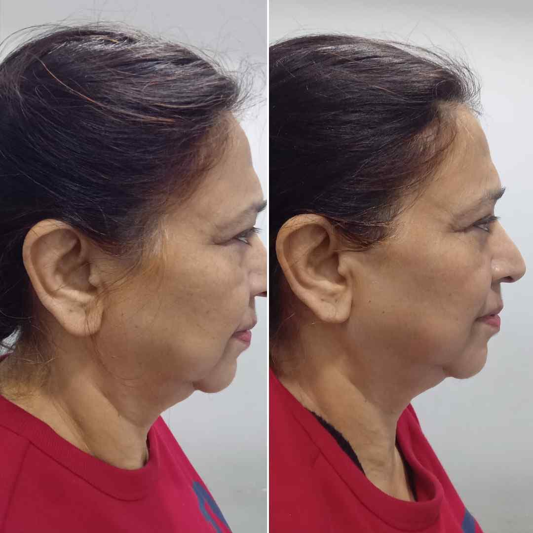 CD-Ultra-Chin-+-Neck.jpg