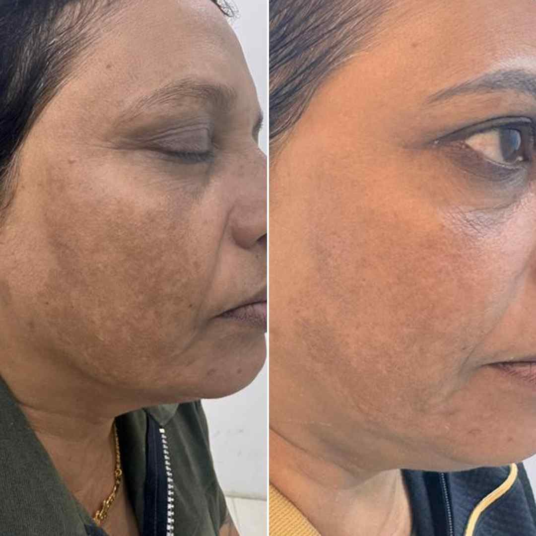 Mesotherapy.jpg
