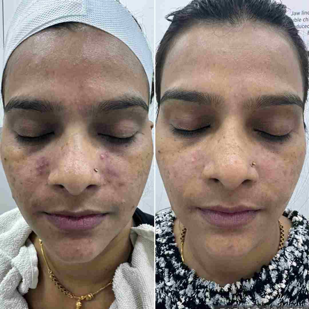 salicylic-peel.jpg