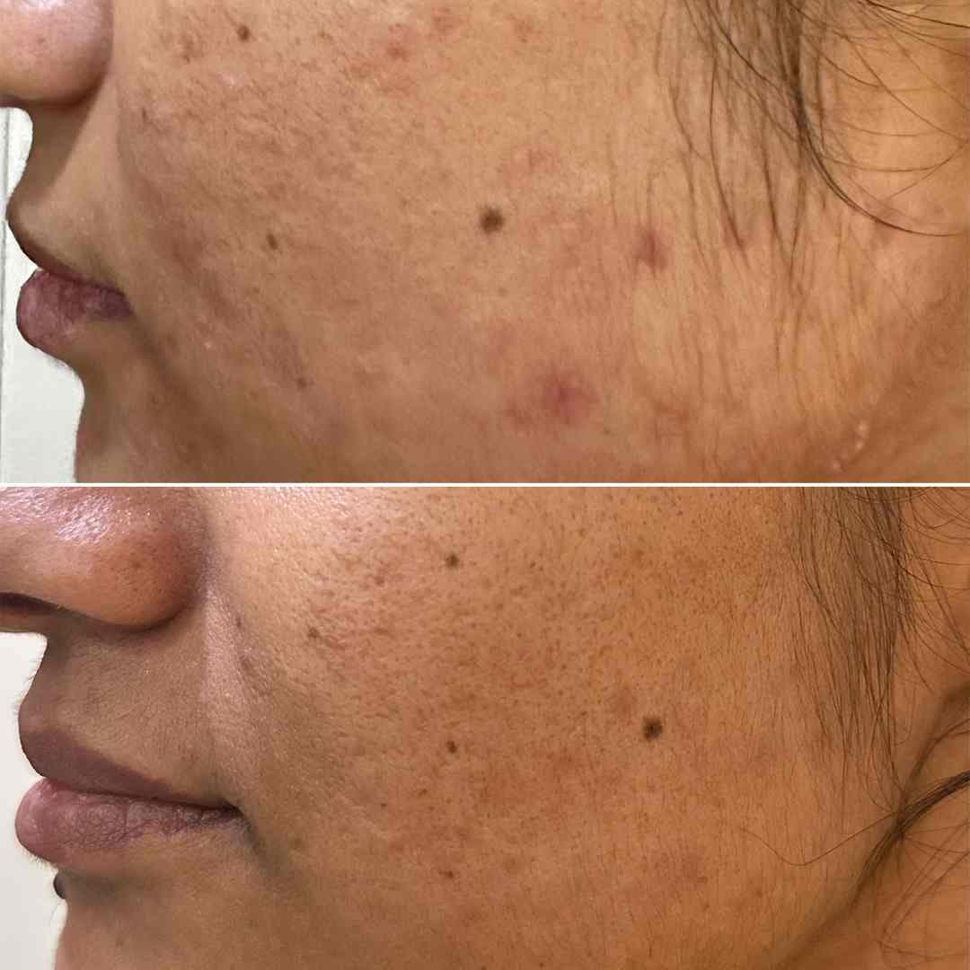 Acne-&-Acne-scar.jpg