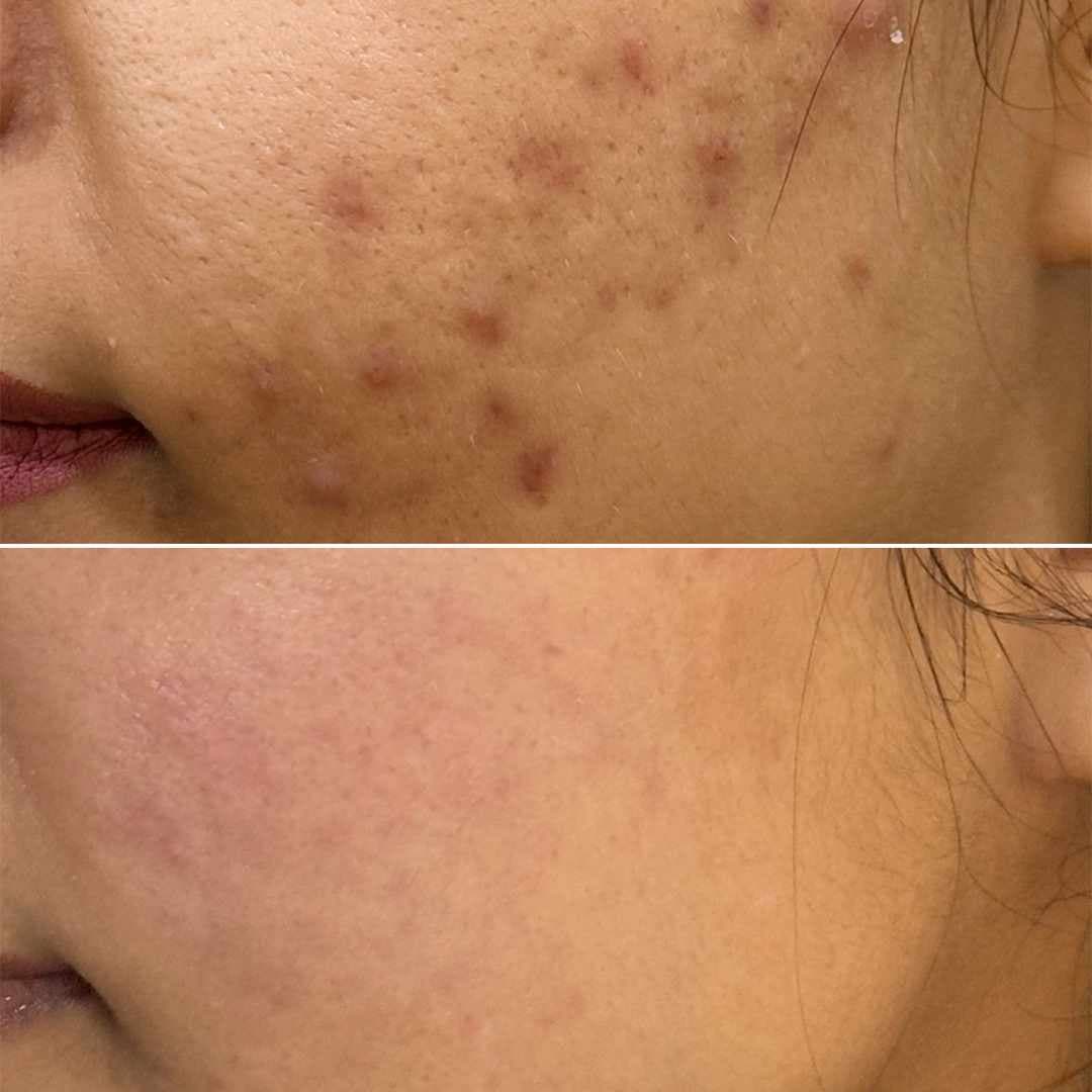 Acne-PIH.jpg