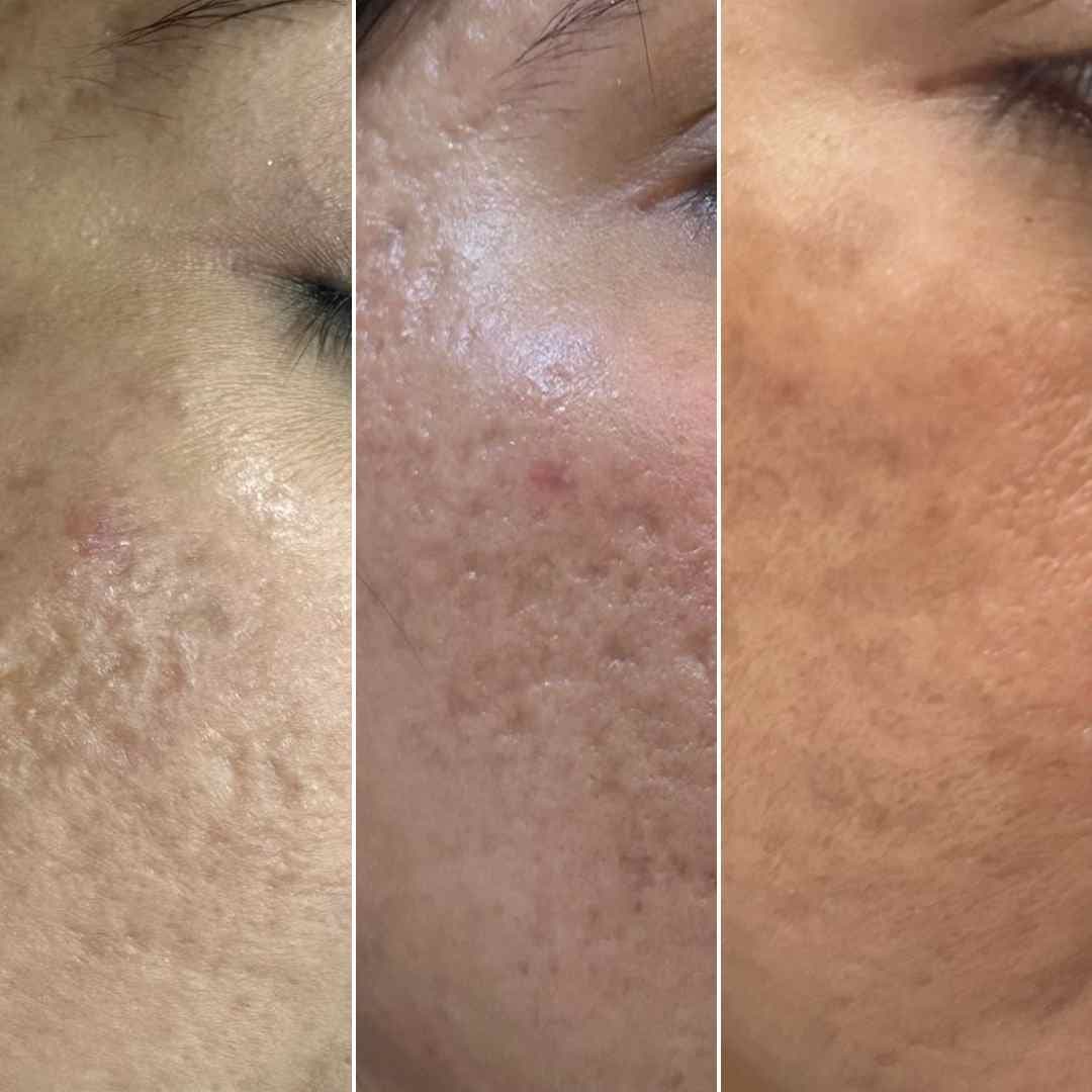 Acne-scar-revision---Threads-with-prp-with-microneedling.jpg