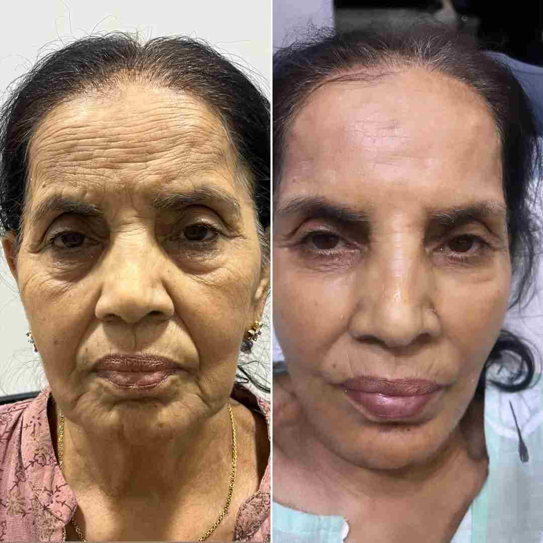 Botox-+-Filler-1a-IMG-20240429-WA0010.jpg