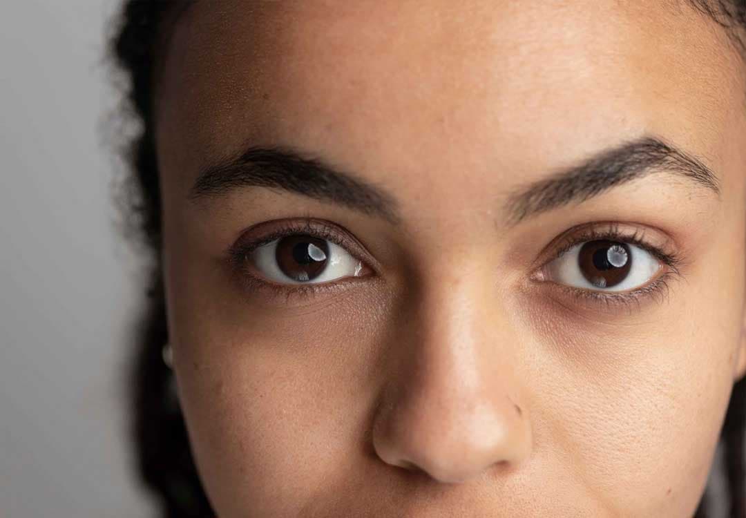 Dark Circles & Puffiness