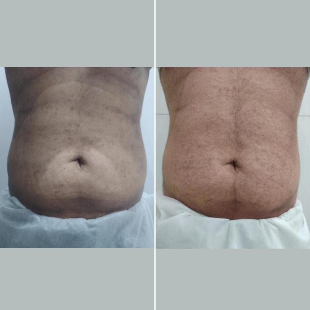EMshape-abdomen-MT.jpg