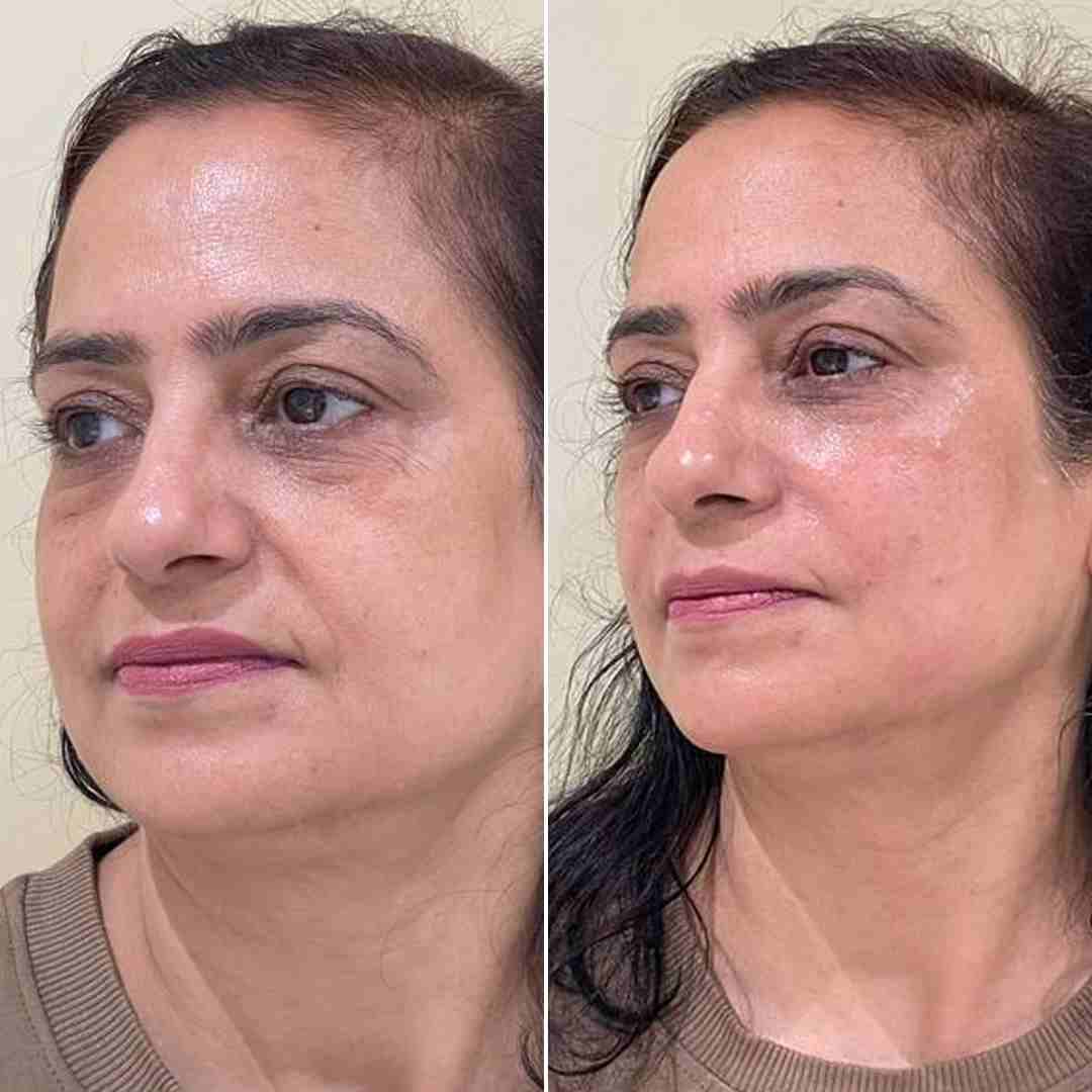 Fillers---Nasolabial-+-Jawline-+-Under-Eye.jpg