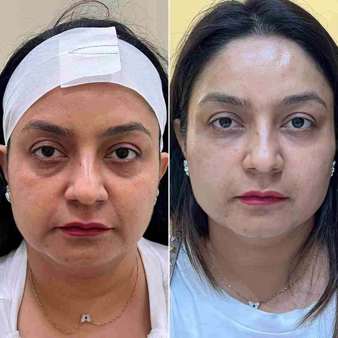 Full-face-filler.jpg