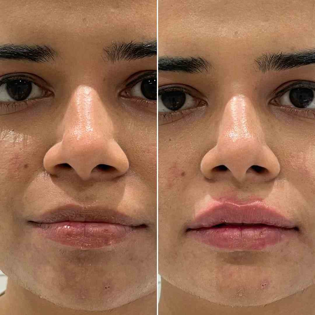 Lip-Filler-4.jpg
