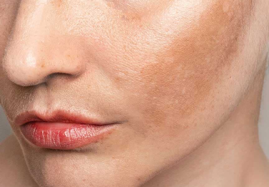 Skin Pigmentation