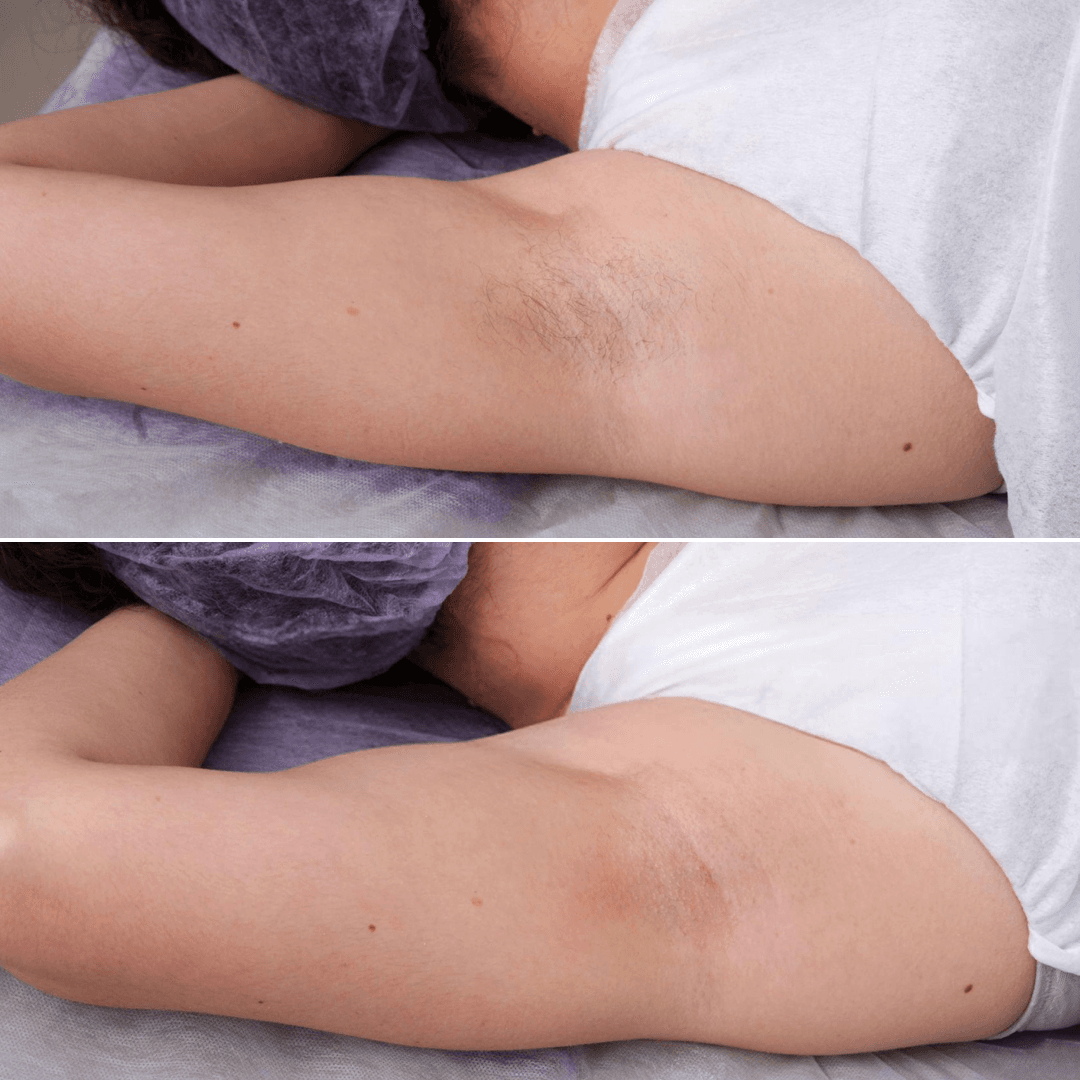 Underarms-4.png