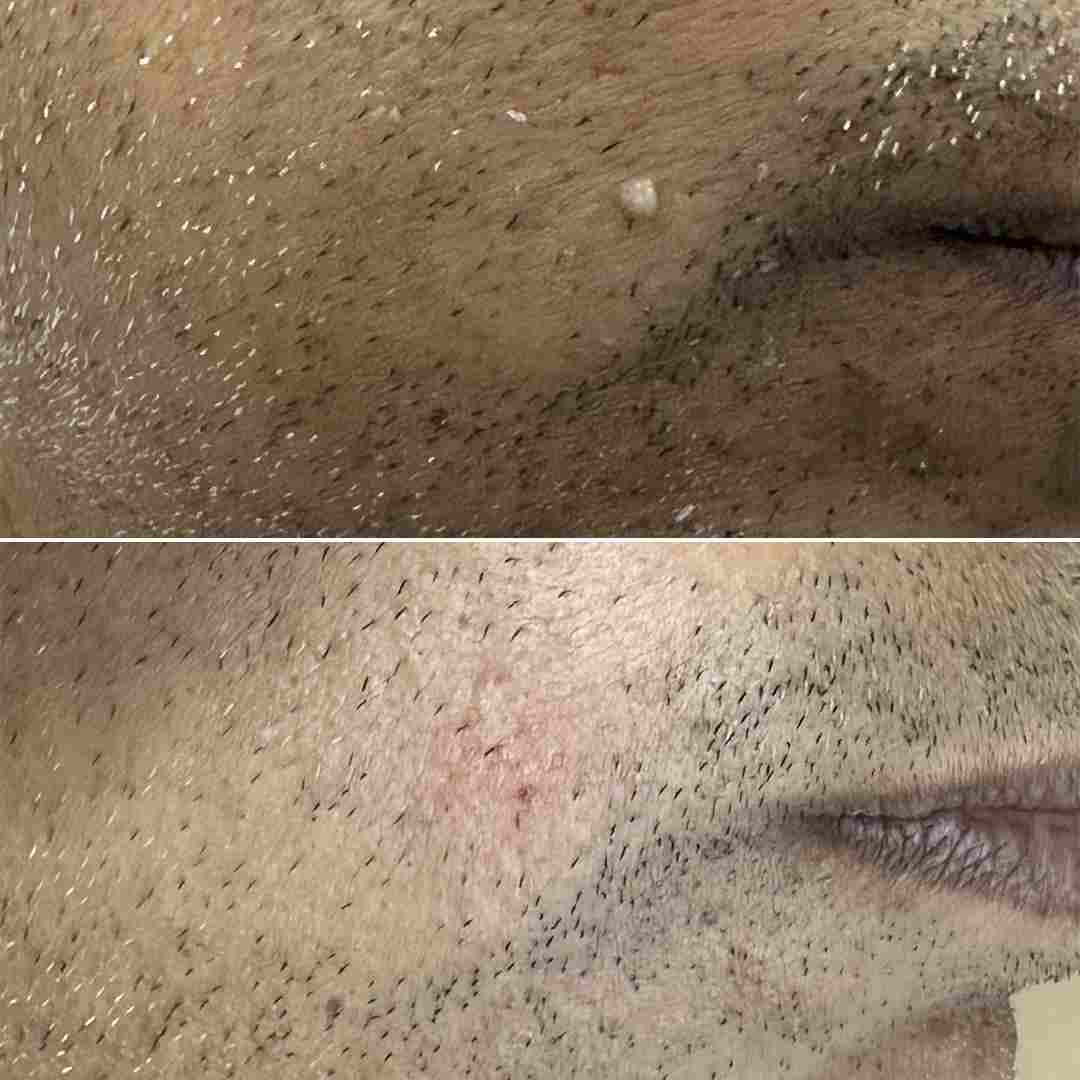 Wart-removal-after.jpg