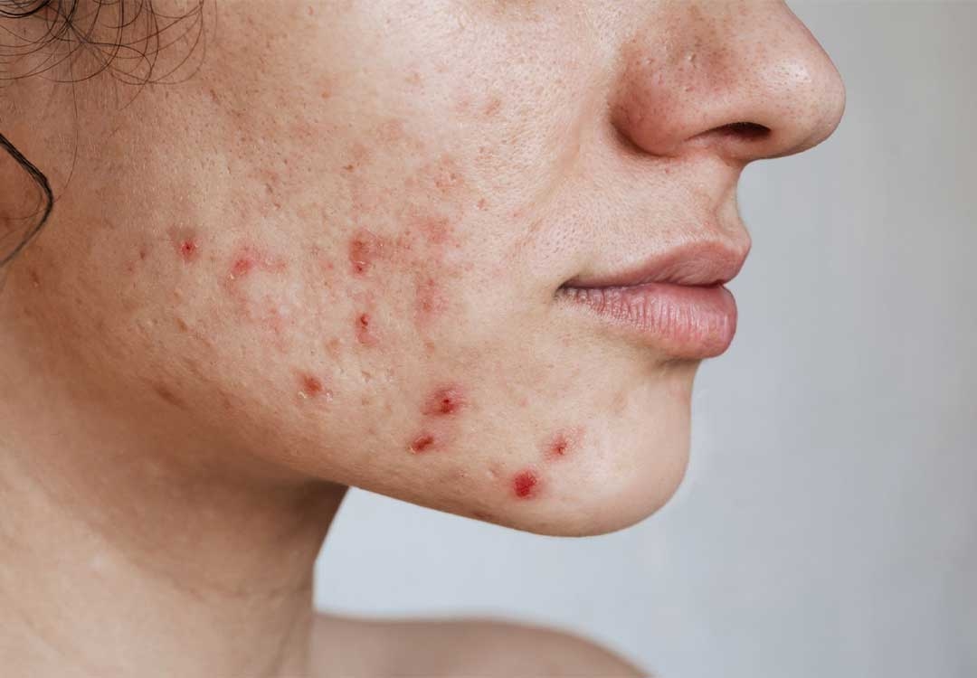 breakouts
