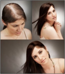 Hair Regrowth Treatment