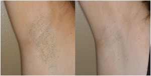 Laser Hair Removal In Delhi