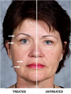 Best Anti Aging Treatment