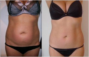 Anti Aging Treatment Delhi