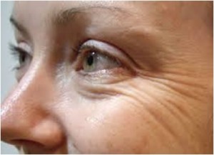 Anti Aging Treatment Delhi