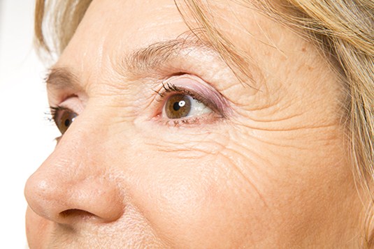 Dermal fillers for acne scars, Dermal fillers side effects, Types of dermal fillers