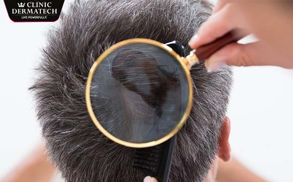 hairfall