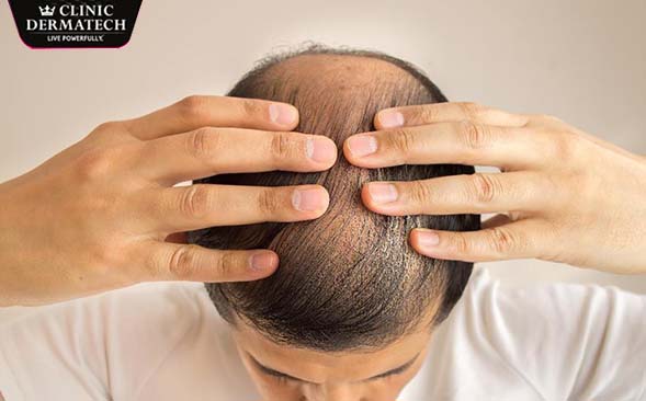 hairfalltreatment