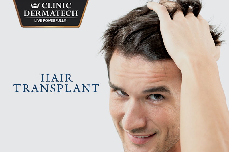 hair transplant