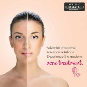 acne-treatment