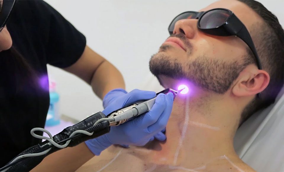 men's laser hair reduction