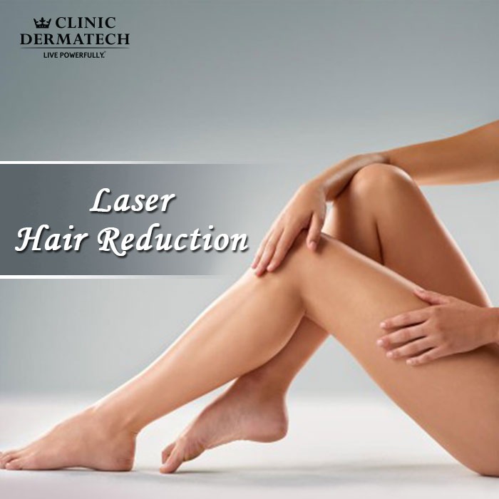 laser hair removal