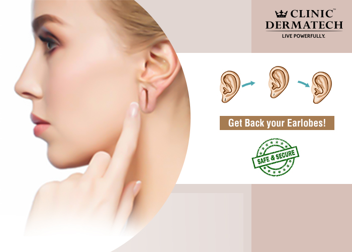 Earlobe-repair