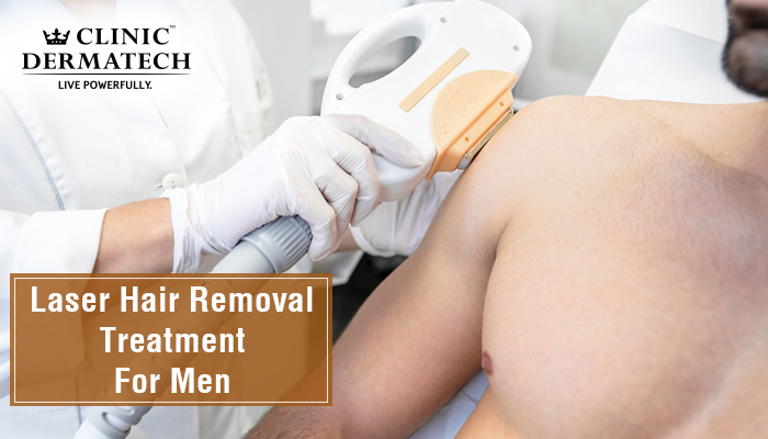 Laser hair removal for men