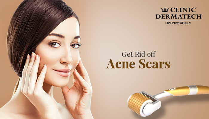 Dermaroller to fill Indented Acne Scars
