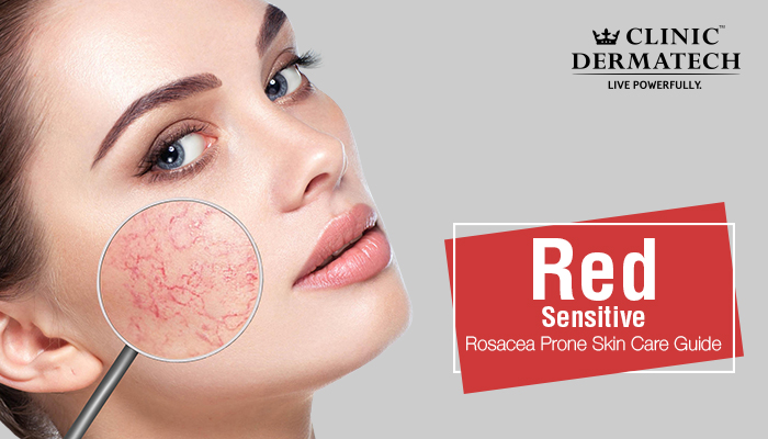 Rosacea Skin Care