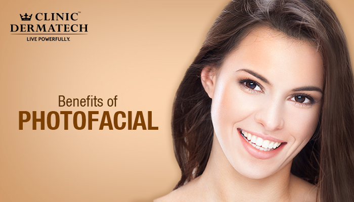 Photo Facial