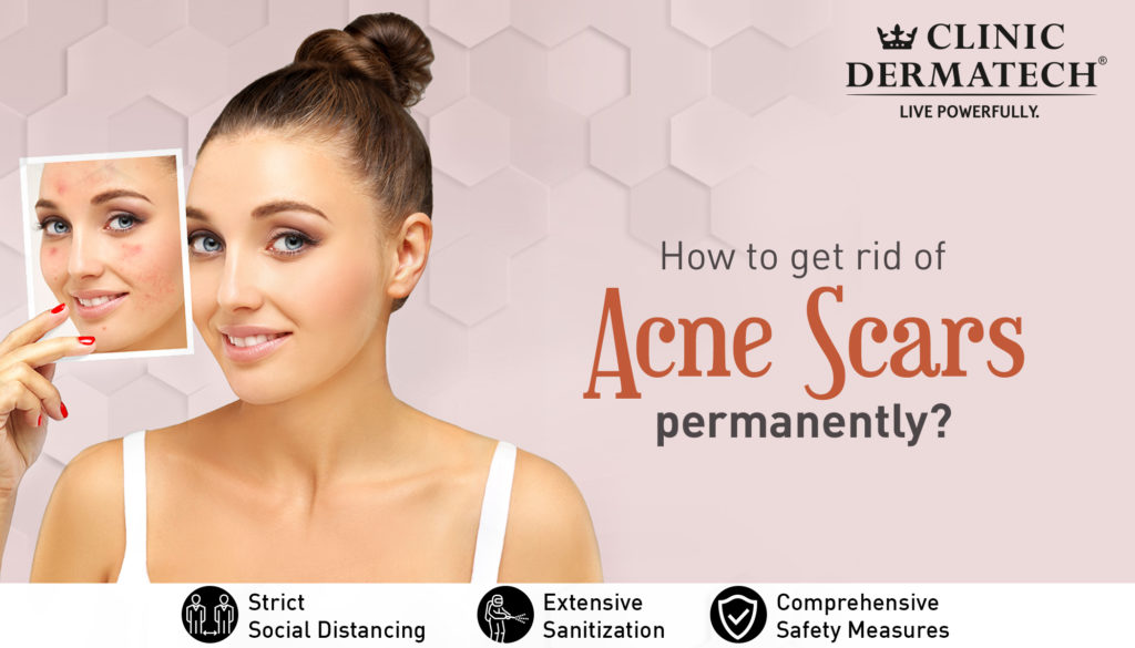 Acne Scars
