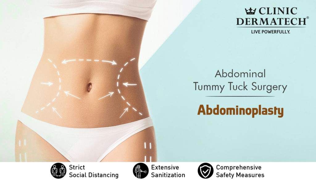 Abdominoplasty