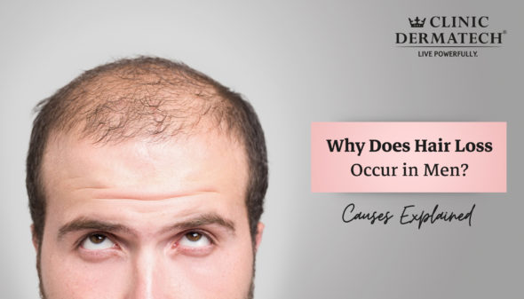 Why Does Hair Loss Occur in Men? Causes Explained