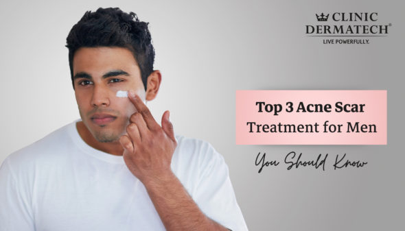 Top 3 Acne Scar Treatment for Men You Should Know