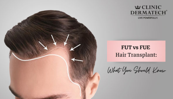 FUT vs FUE Hair Transplant: What You Should Know
