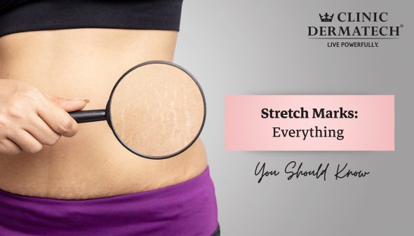 Stretch Marks: Everything You Should Know