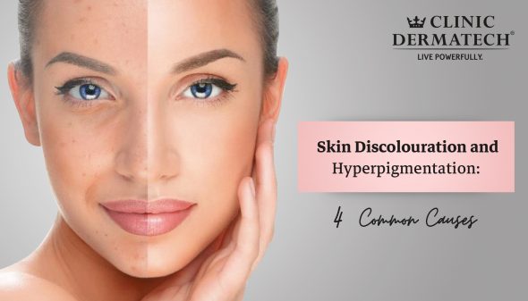 Skin Discolouration and Hyperpigmentation: 4 Common Causes