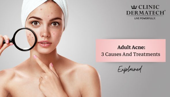 Adult Acne: 3 Causes And Treatments Explained