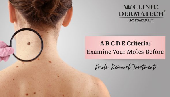 A B C D E Criteria: Examine Your Moles Before Mole Removal Treatment