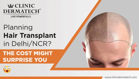 Planning Hair Transplant in Delhi/NCR? The Cost Might Surprise You