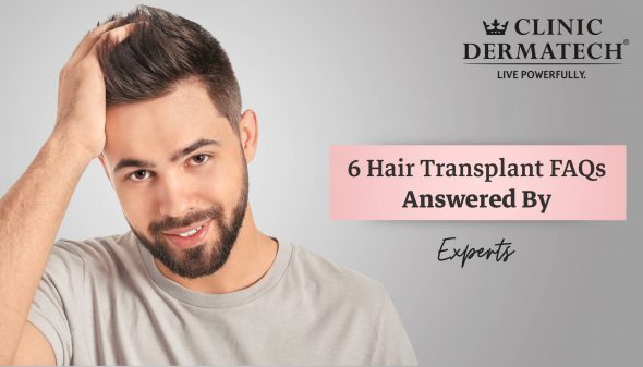 6 Hair Transplant FAQs Answered By Experts