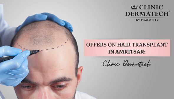 Offers On Hair Transplant In Amritsar: Clinic Dermatech