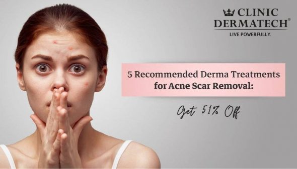 5 Recommended Derma Treatments for Acne Scar Removal: Get 51% Off