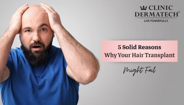 5 Solid Reasons Why Your Hair Transplant Might Fail