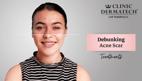 Debunking Acne Scar Treatments