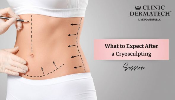 What to Expect After a Cryosculpting Session